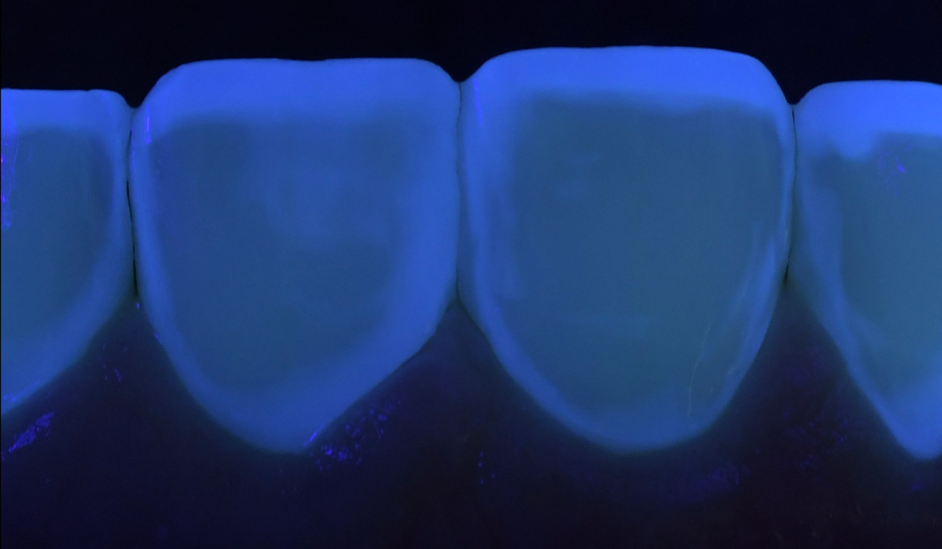 Figure 2: Controlling structure removal with UV light, which nicely reveals the old composite.